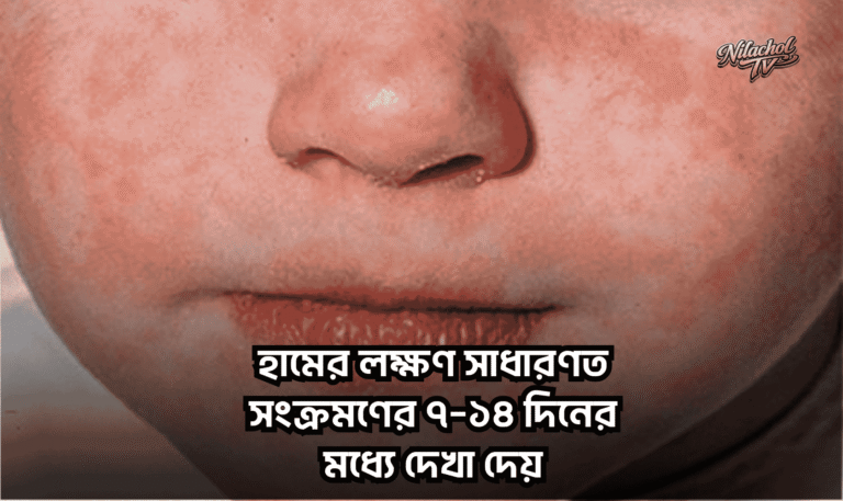 হামের লক্ষণ ও করণীয় (আপডেট ২০২৬)